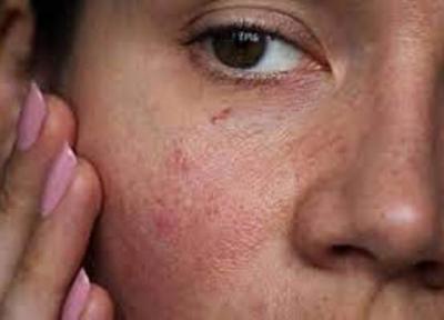 سندرم پوست حساس چیست؟