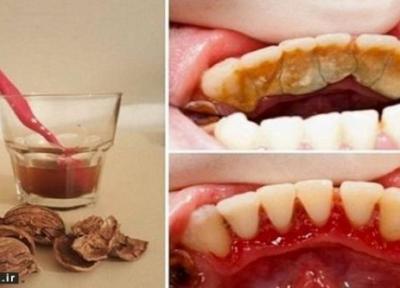 سفید کردن دندان با روش طبیعی